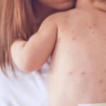 Скарлатина висип