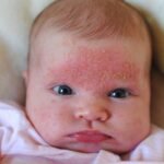акне новонароджених