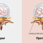 протрузія це