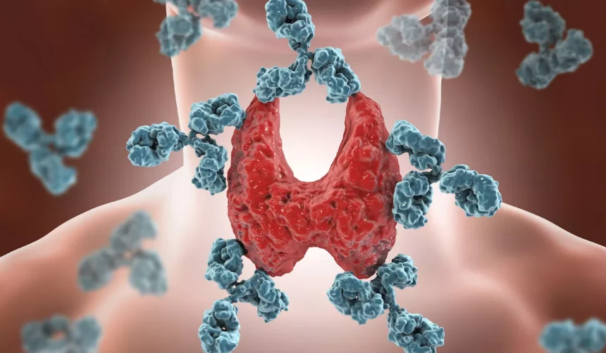 аутоімунний тиреоїдит