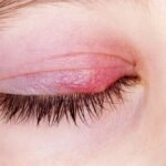 ячмінь на оці