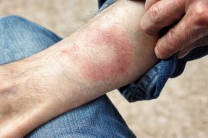 хвороба лайма