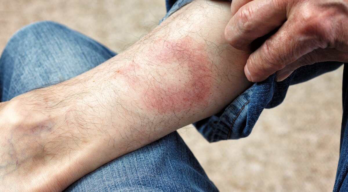 хвороба лайма